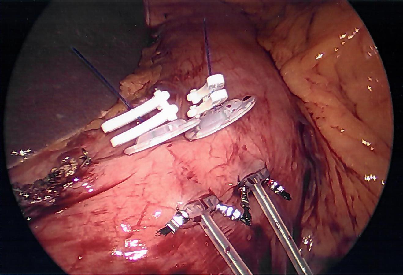 Lap Gastric Stim Without Fat A