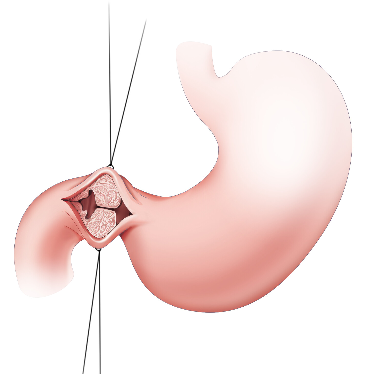 Illustration of a pyloroplasty, with the two cut ends of the pylorus held apart