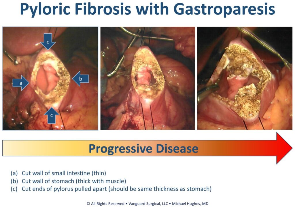 Three intraoperative photographs of the divided pylorus showing progressive fibrosis. Labels: (a) cut wall of small intestine, thin; (b) cut wall of stomach, thick with muscle; (c) cut ends of pylorus pulled apart, which should be the same thickness as the stomach.