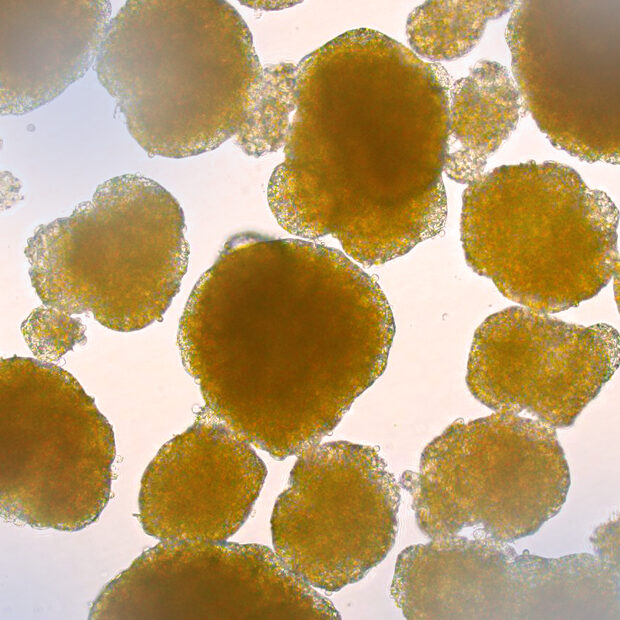 vanguard-chronic-pancreatitis-cells